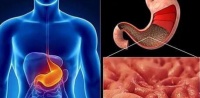 مواجهة التهاب المعدة بالحليب يصعب التشخيص والعلاج